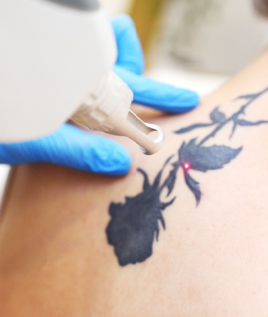 Remoção de tatuagem - IVA | Medical Institute